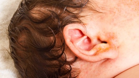 耳のニオイはアレルギーの可能性