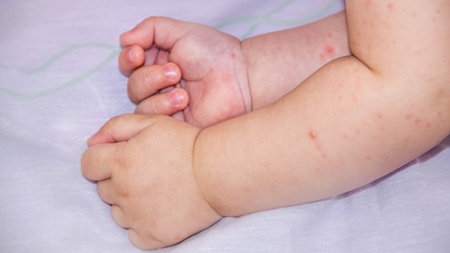 アレルギーマーチ　乳児湿疹～アトピー～花粉症