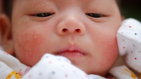 乳児湿疹について