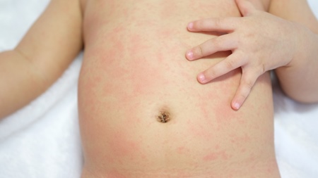 赤ちゃんのアトピー性皮膚炎と乳児湿疹の違いとは？