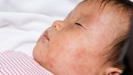 赤ちゃんのアレルギーの発症について