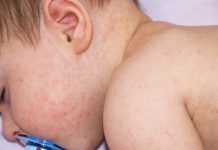 赤ちゃんのアレルギーについて知っておきたいこと 原因は　症状は　食べ物は　検査方法は　 離乳食は