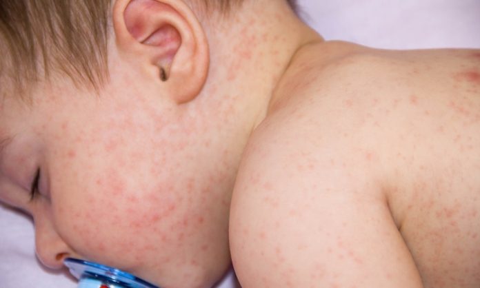 赤ちゃんのアレルギーについて知っておきたいこと 原因は　症状は　食べ物は　検査方法は　 離乳食は