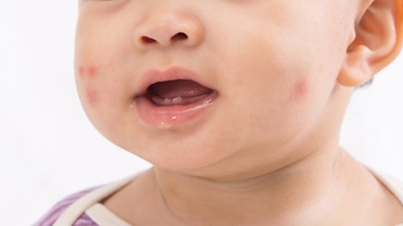 乳児湿疹で学んだこと 治らないセカンドオピニオン