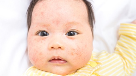 乳児湿疹に白ニキビ～脂漏性湿疹